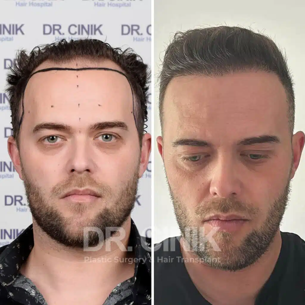 Before and after comparison of a FUE hair transplant with 4000 grafts, showing results 9 months post-procedure. Initial Norwood V pattern showcasing significant transformation.