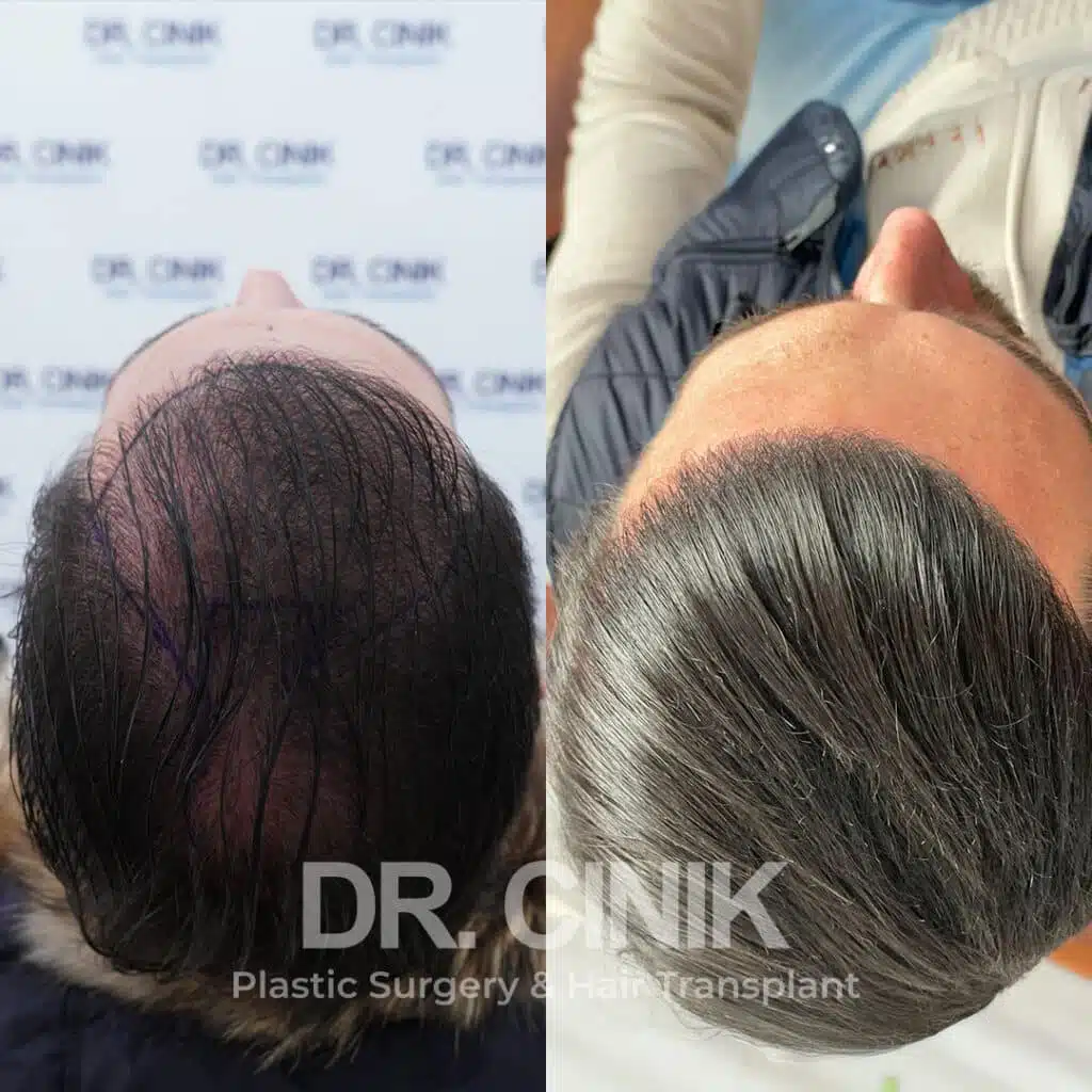 Before and after comparison of a FUE Saphir hair transplant with 4000 grafts, showing results 12 months post-procedure. Initial Norwood V pattern showcasing significant transformation.