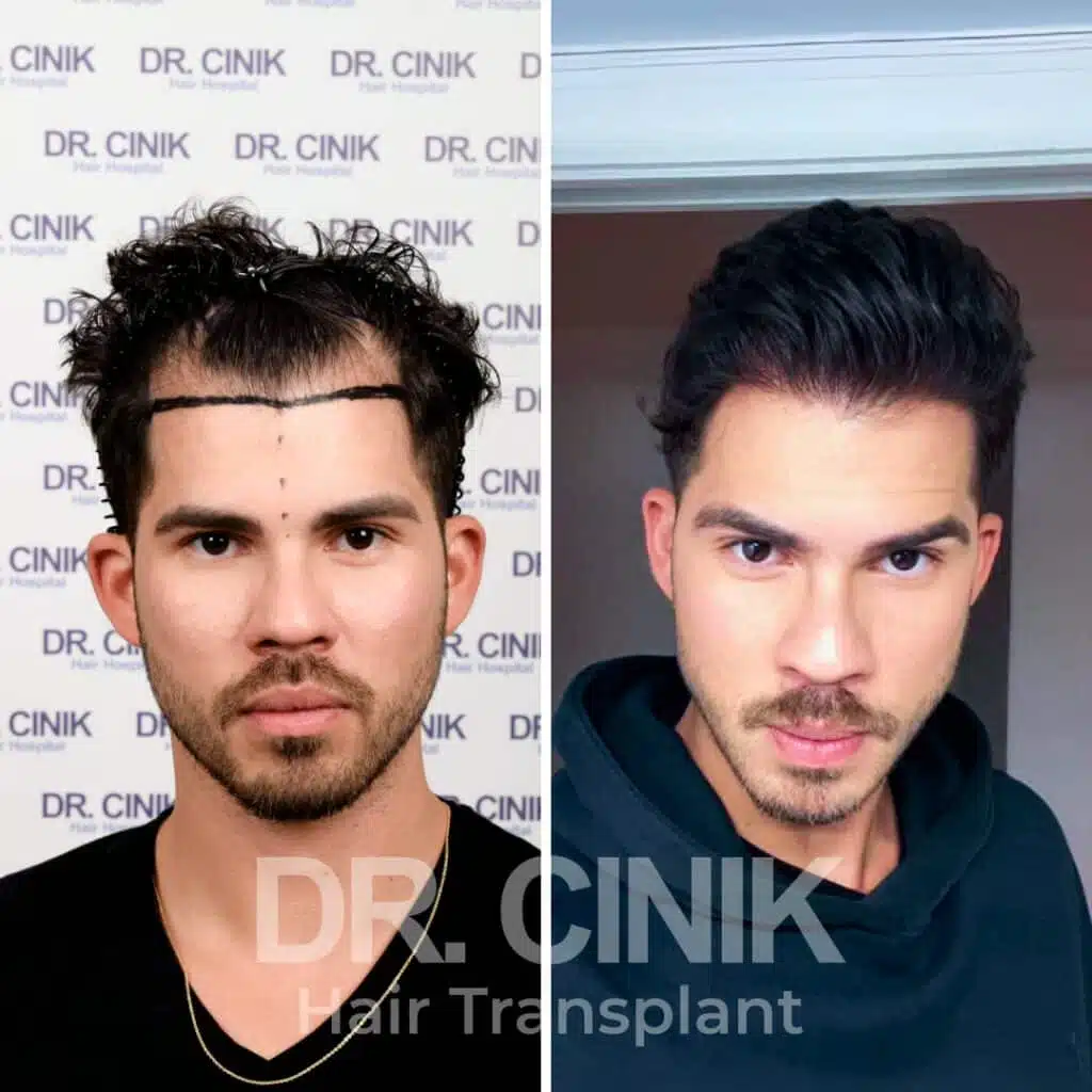 Before and after comparison of a DHI hair transplant with 3850 grafts, showing results 12 months post-procedure. Initial Norwood V pattern showcasing transformation.