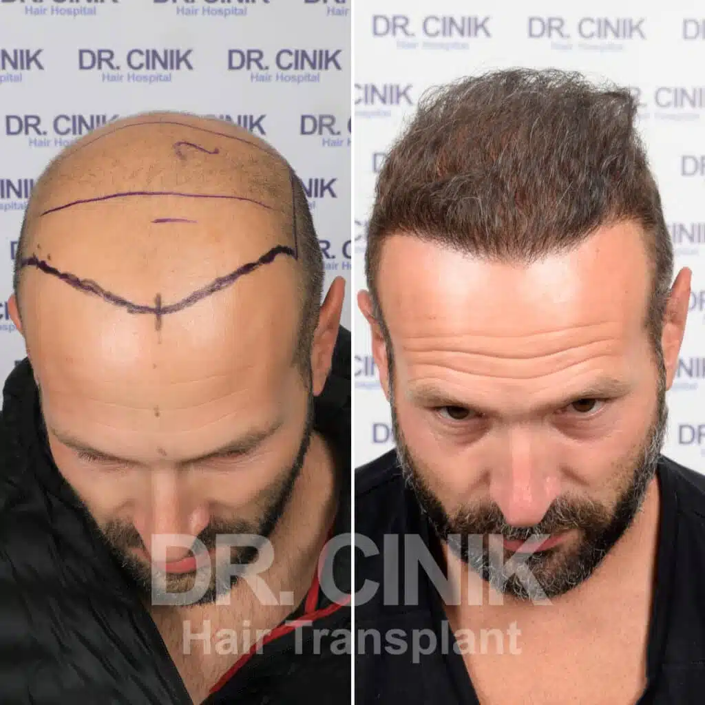 Before and after comparison of a FUE beard transplant with 3900 grafts, showing results 12 months post-procedure. Showcases transformation from initial sparse beard to fuller facial hair.