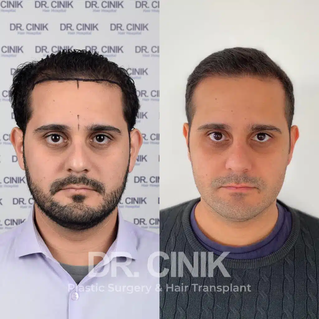 Before and after comparison of a FUE Saphir hair transplant with 4200 grafts, showing results 12 months post-procedure. Initial Norwood V pattern showcasing significant transformation.