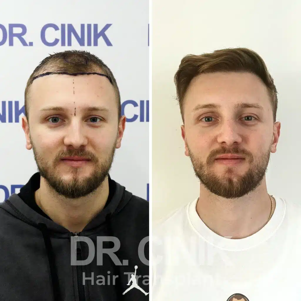 Before and after comparison of a DHI hair transplant with 2500 grafts, showing results 12 months post-procedure. Initial Norwood III pattern showcasing transformation.