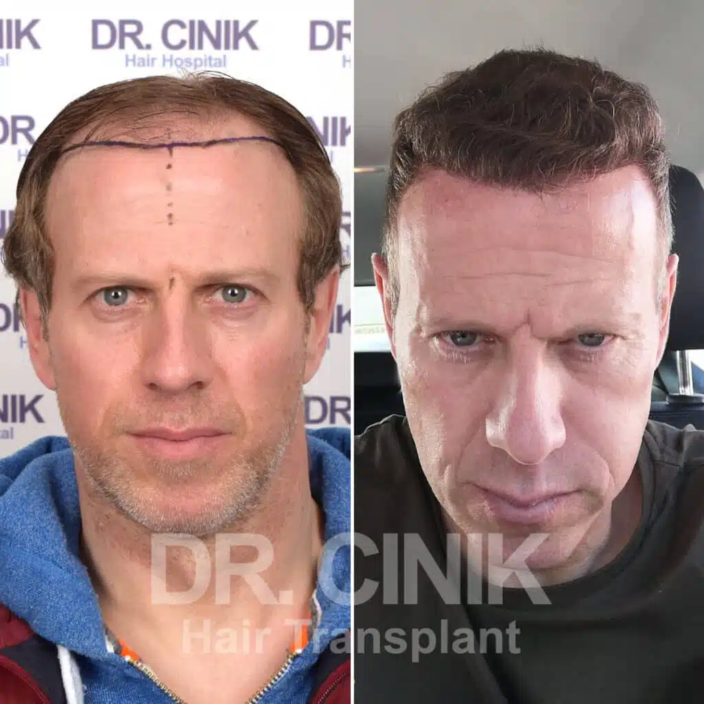 Before and after comparison of a FUE hair transplant with 4400 grafts, showing results 12 months post-procedure. Initial Norwood V pattern showcasing significant transformation.