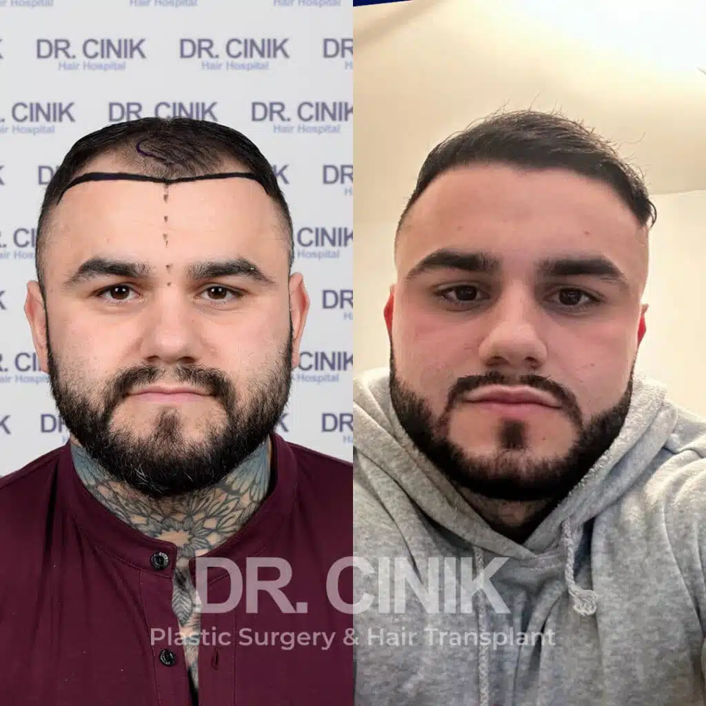 Before and after comparison of a FUE Saphir hair transplant with 3600 grafts, showing results 12 months post-procedure. Initial Norwood V pattern showcasing transformation.