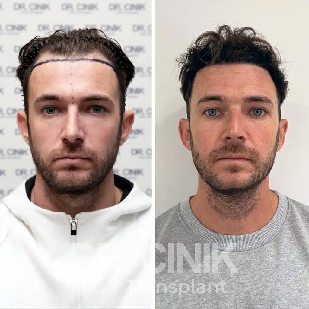 Before and after comparison of a DHI hair transplant with 3400 grafts, showing results 12 months post-procedure. Initial Norwood V pattern showcasing significant transformation.