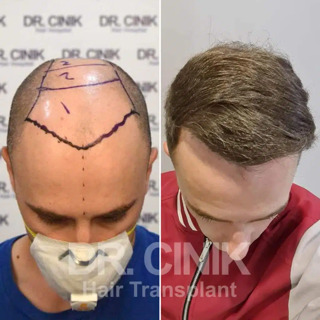 Before and after comparison of a FUE hair transplant with 4600 grafts, showing results 12 months post-procedure. Initial Norwood VII pattern showcasing significant transformation.