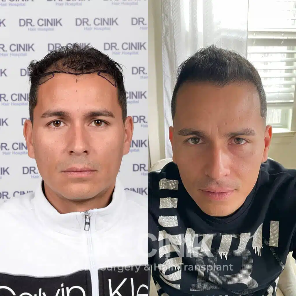 Before and after comparison of a FUE Saphir hair transplant with 3600 grafts, showing results 9 months post-procedure. Initial Norwood V pattern showcasing transformation.