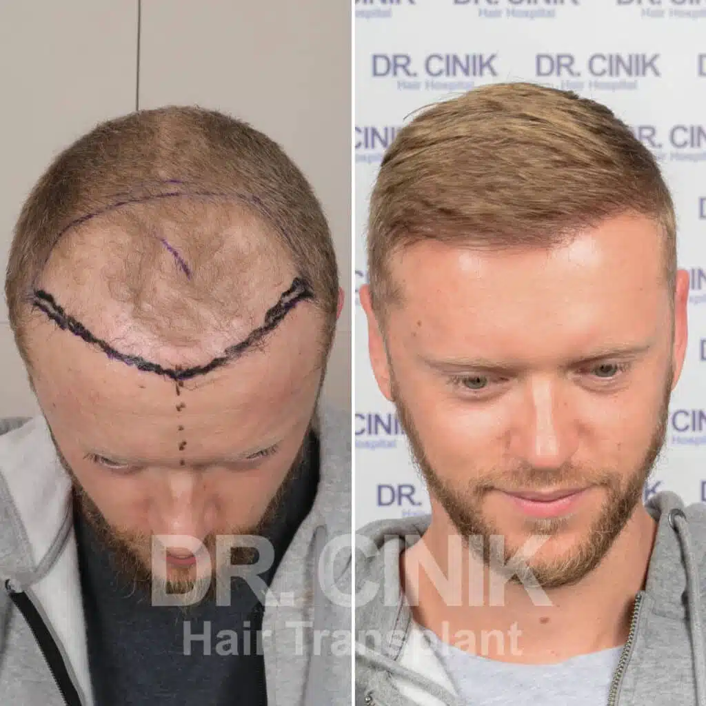 Before and after comparison of a FUE hair transplant with 3700 grafts, showing results 12 months post-procedure. Initial Norwood V pattern showcasing significant transformation.