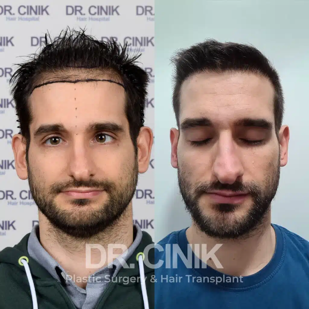 Before and after comparison of a FUE Saphir hair transplant with 3400 grafts, showing results 9 months post-procedure. Initial Norwood V pattern showcasing transformation.