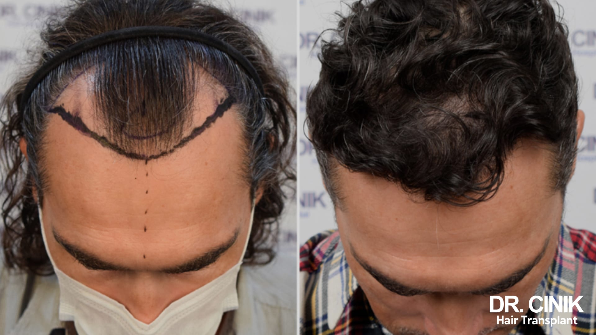 Greffe de cheveux : rsultats aprs 1 an  Dr Cinik