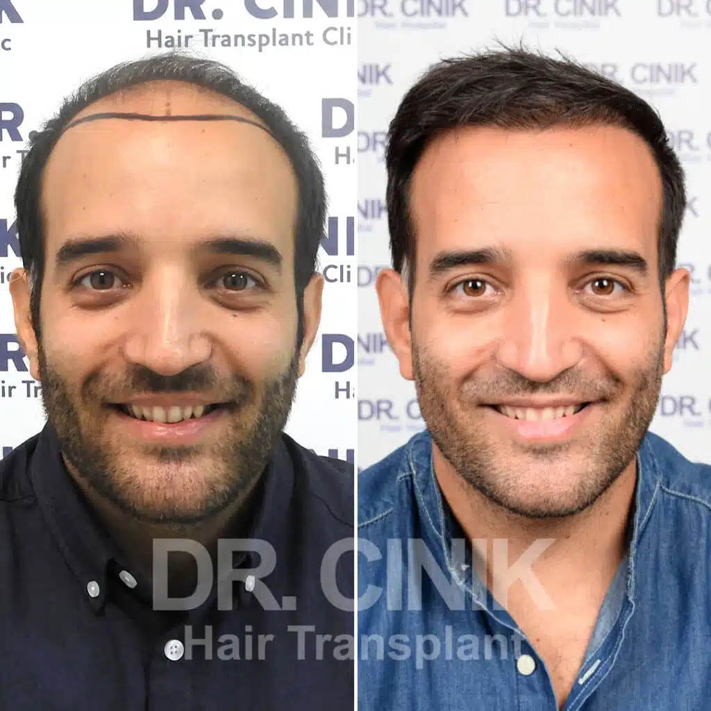 Before and after comparison of a FUE hair transplant with 3400 grafts, showing results 12 months post-procedure. Initial Norwood V pattern showcasing significant transformation.