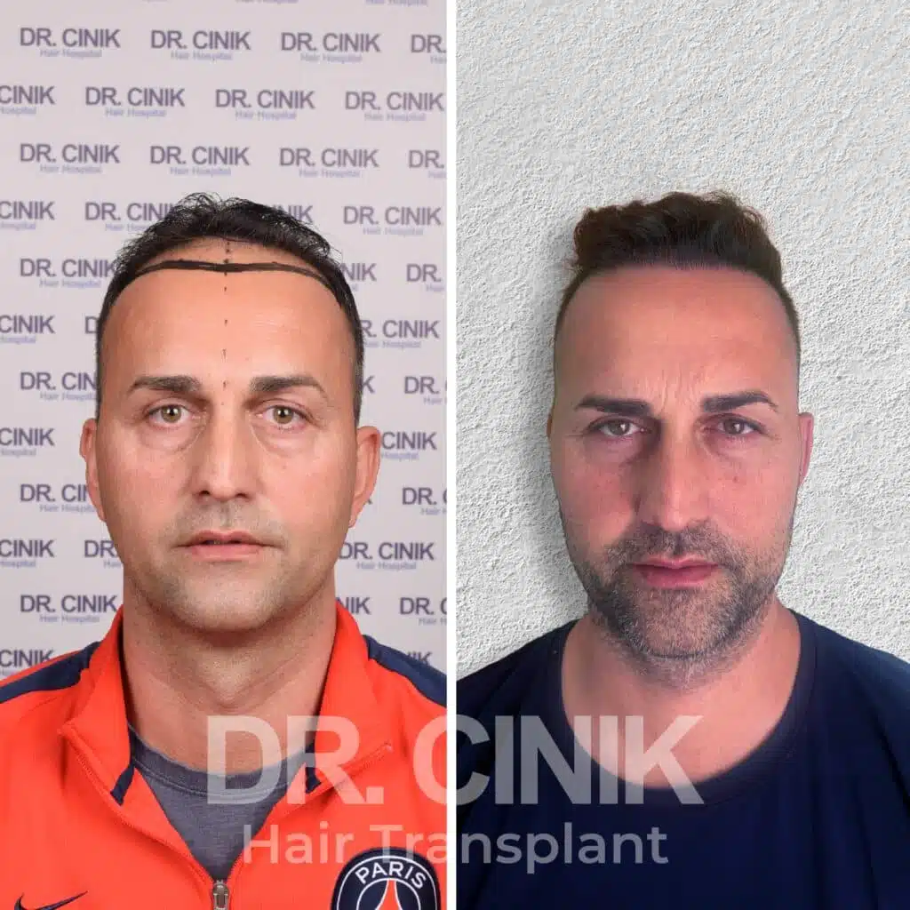 Before and after comparison of a DHI hair transplant with 4200 grafts, showing results 12 months post-procedure. Initial Norwood V pattern showcasing significant transformation.