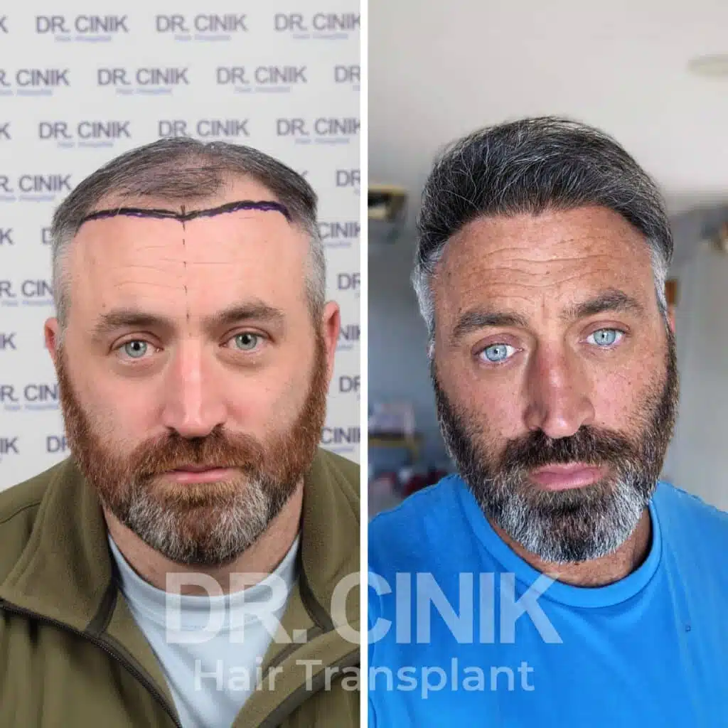 Before and after comparison of a DHI hair transplant with 4450 grafts, showing results 12 months post-procedure. Initial Norwood V pattern showcasing significant transformation.