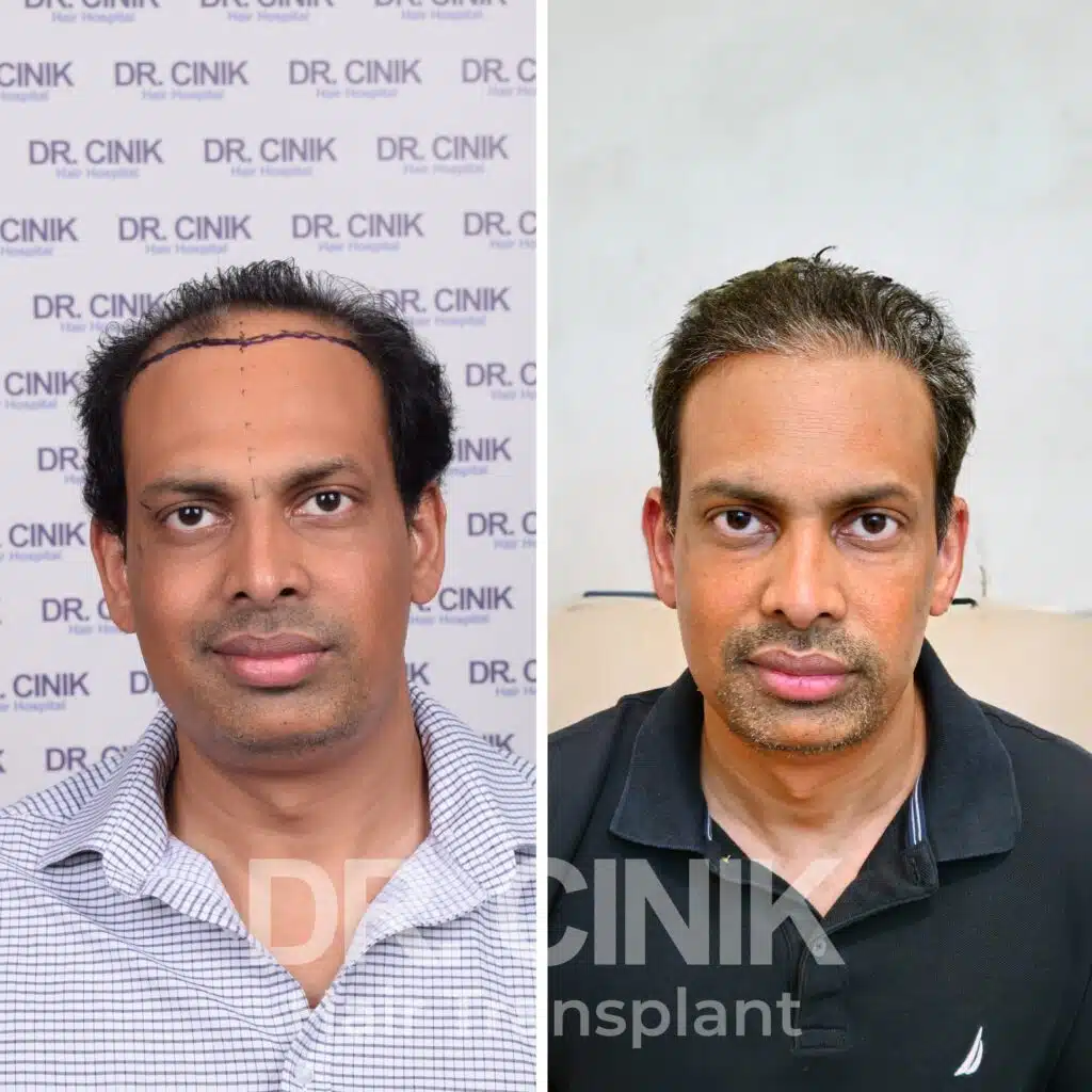 Before and after comparison of a DHI hair transplant with 4100 grafts, showing results 12 months post-procedure. Initial Norwood V pattern showcasing significant transformation.