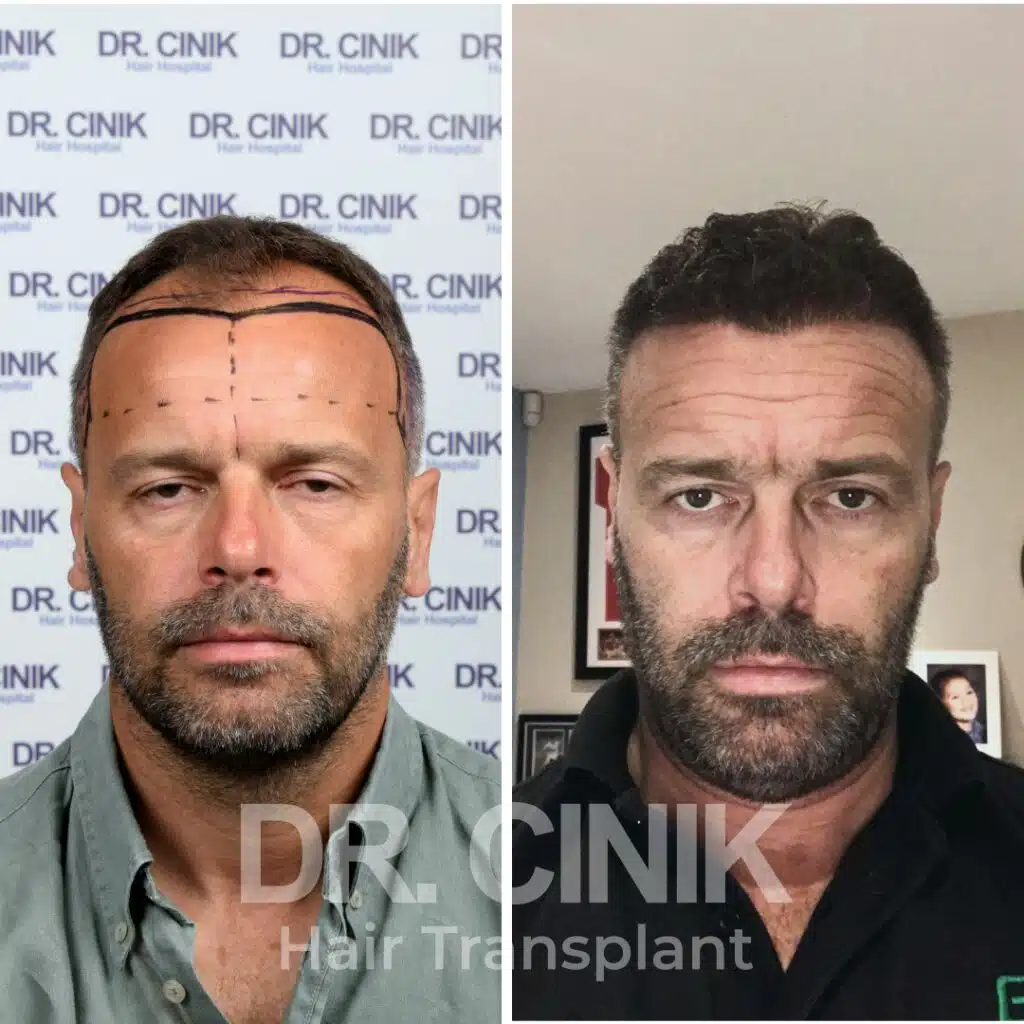 Before and after comparison of a DHI hair transplant with 4250 grafts, showing results 12 months post-procedure. Initial Norwood V pattern showcasing significant transformation.