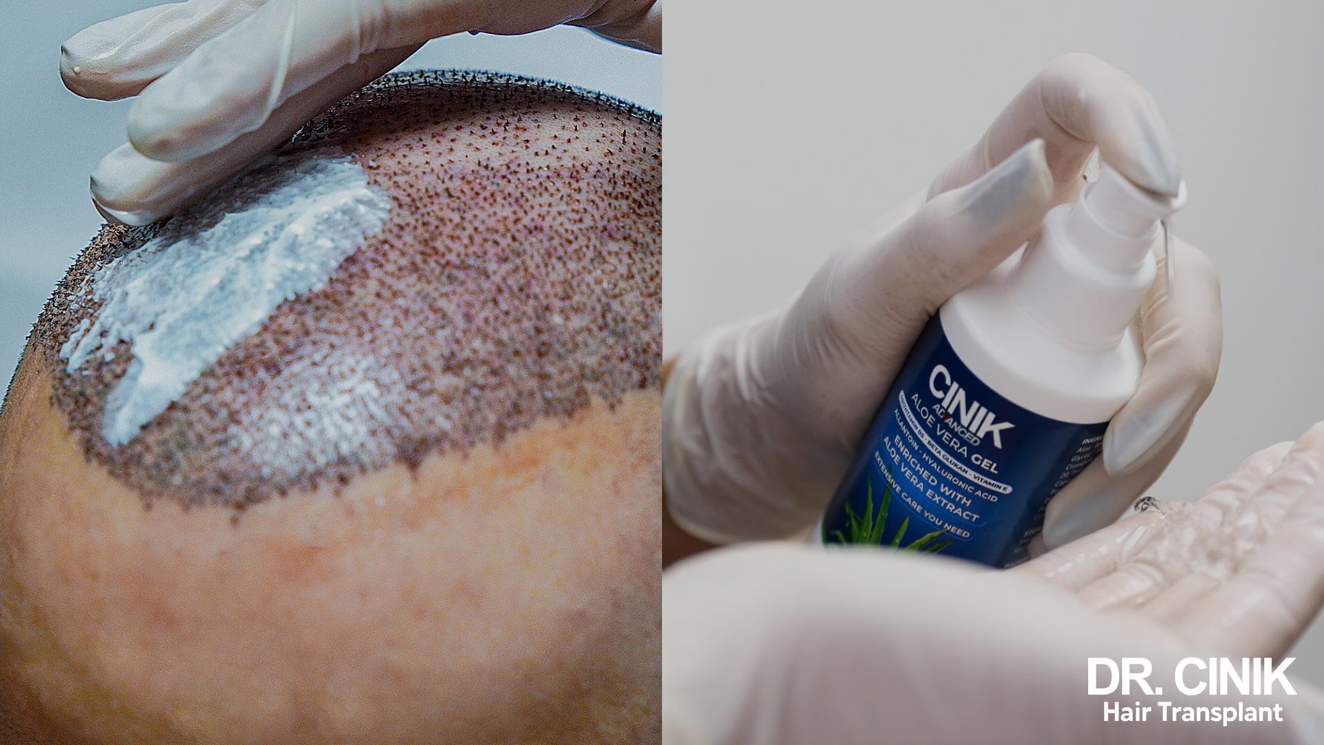 Hair transplant 5 days after - Dr Cinik
