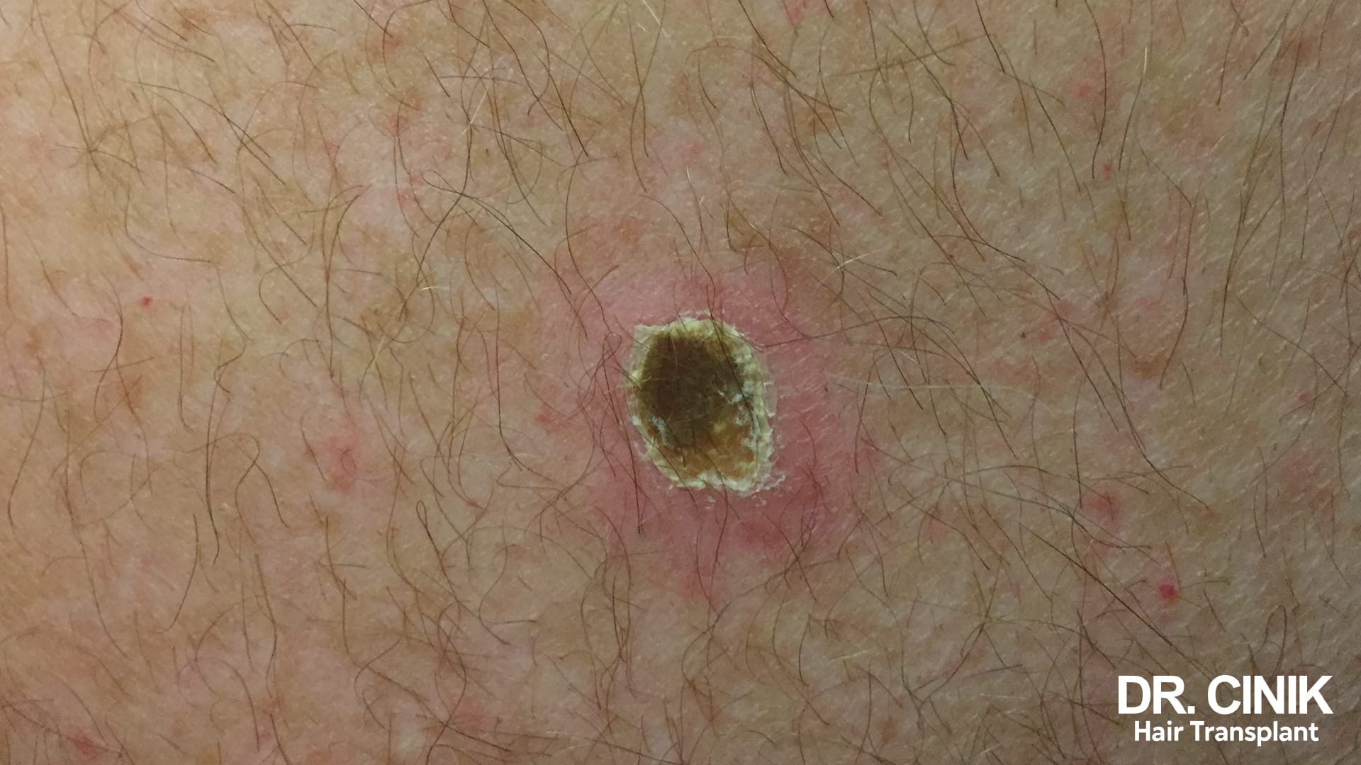 Folliculite Causes, Symptômes et Traitements Dr Cinik — free download