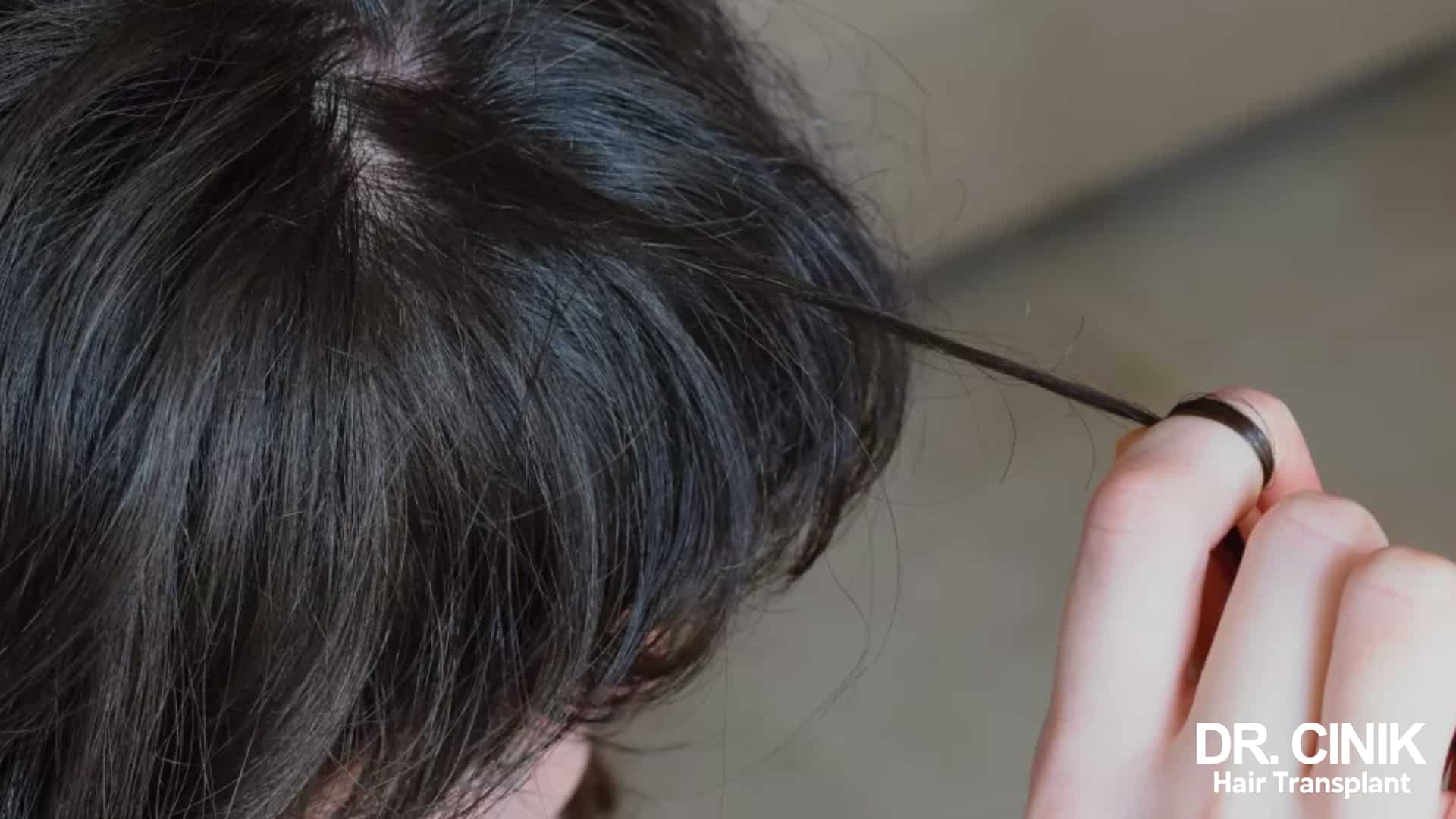 Trichotillomania: Understanding and Treating the Compulsive Hair Pulling  Disorder | Dr. Cinik
