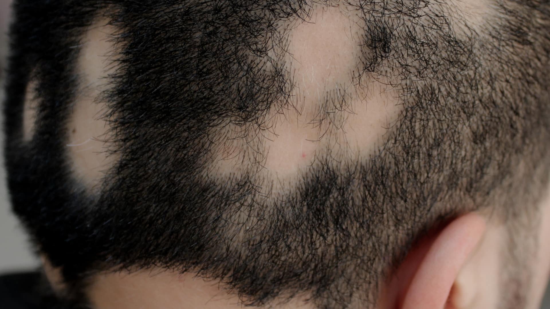 Alopecia Areata: a little-known autoimmune disease