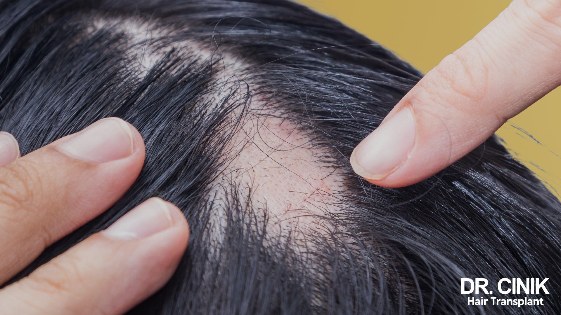 semaglutide hair loss reversible side effects Ozempic and hair loss: should you actually be worried?